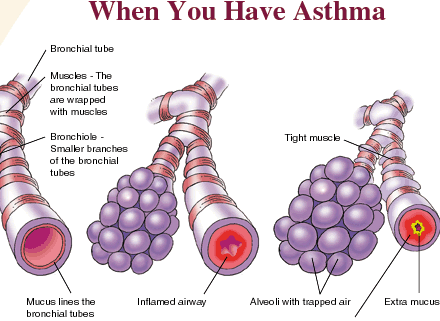 how-you-get-asthma