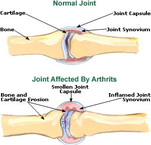 arthritis-picture